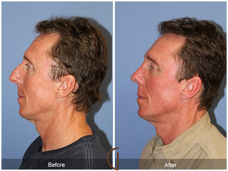Rhinoplasty Nose Surgery Redondo Beach CA 59 Image