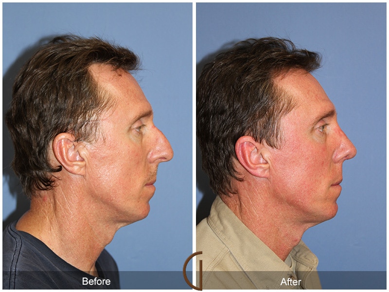 Rhinoplasty Nose Surgery Redondo Beach CA 59 Image