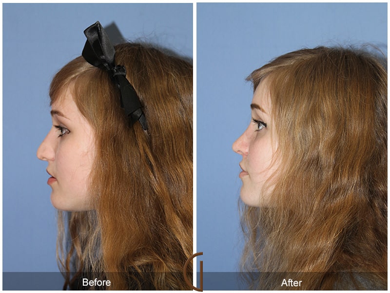 Rhinoplasty Nose Surgery Rancho Santa Fe CA 60 Image