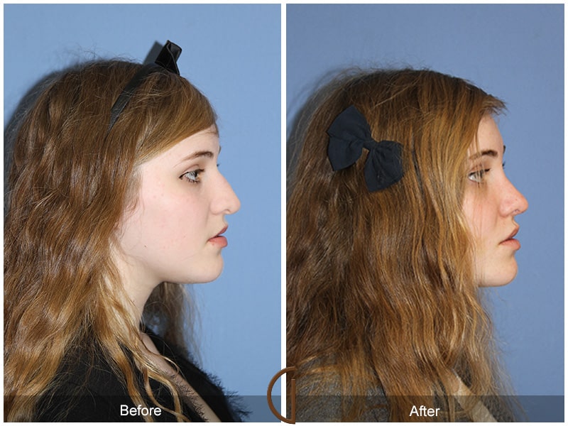 Rhinoplasty Nose Surgery Rancho Santa Fe CA 60 Image