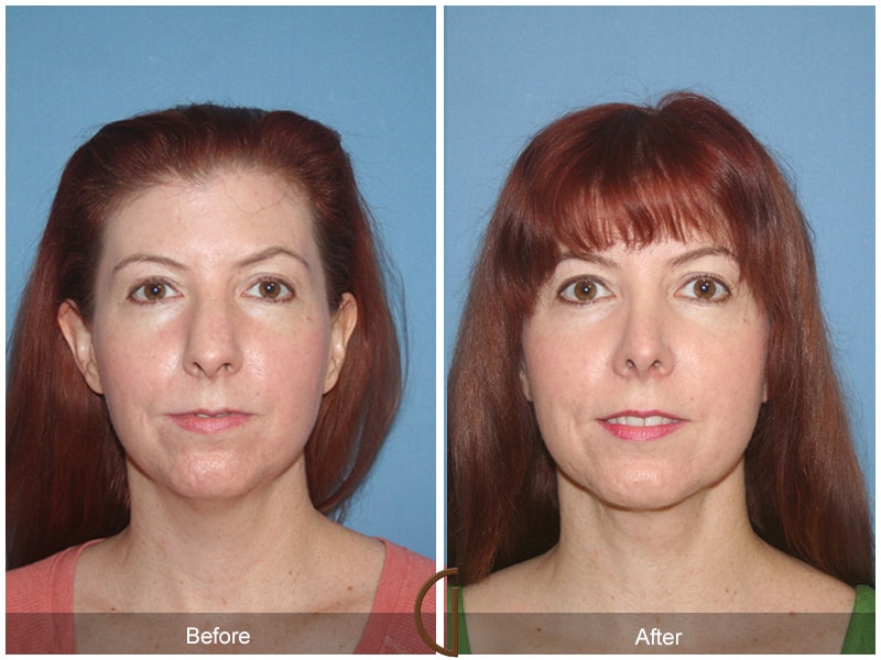 Rhinoplasty Nose Surgery Hasley Canyon CA 61 Image