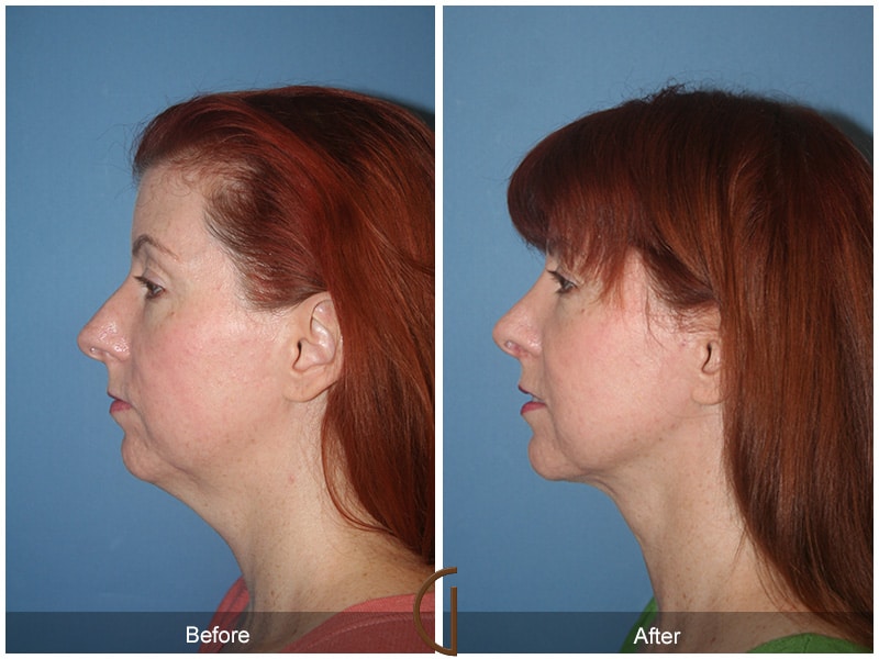 Rhinoplasty Nose Surgery Hasley Canyon CA 61 Image