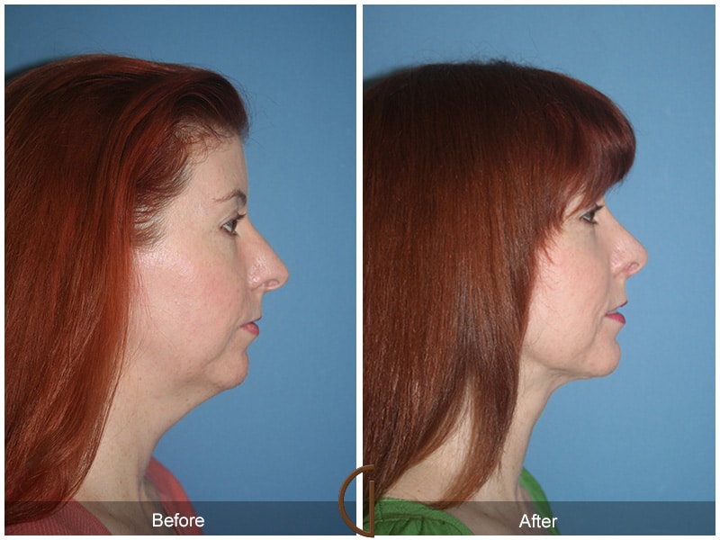 Rhinoplasty Nose Surgery Hasley Canyon CA 61 Image