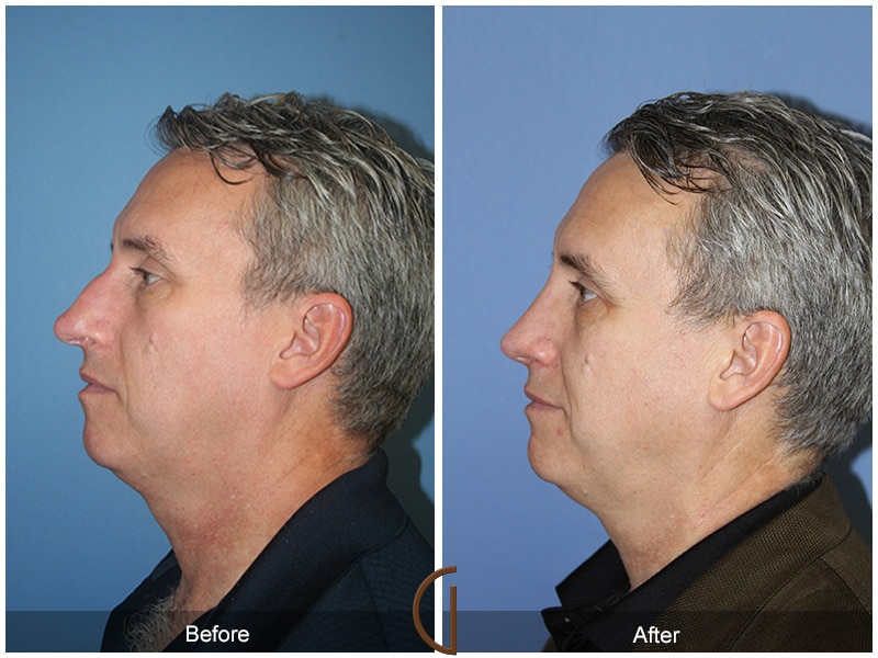 Rhinoplasty Nose Surgery Walnut CA 62 Image