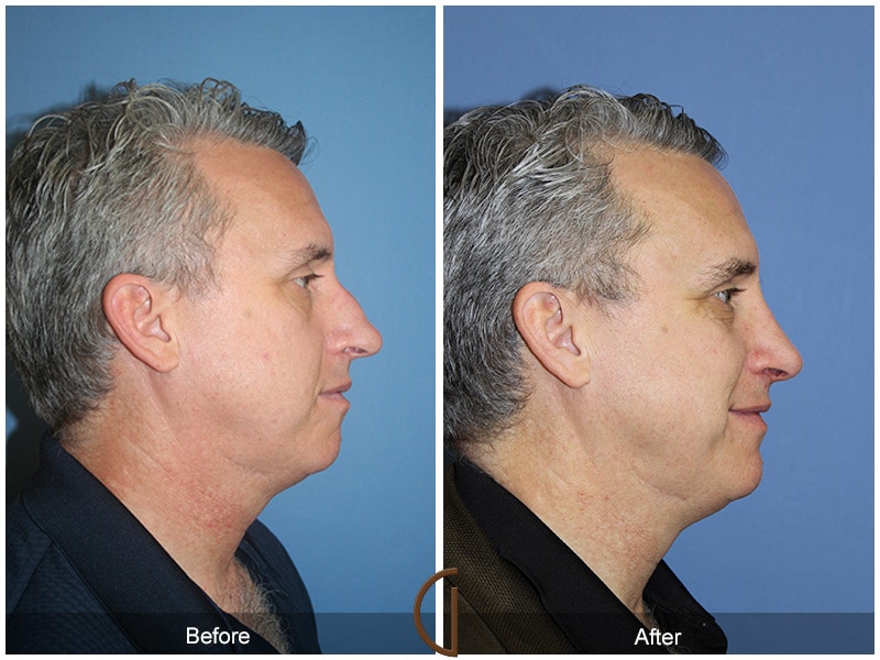 Rhinoplasty Nose Surgery Walnut CA 62 Image