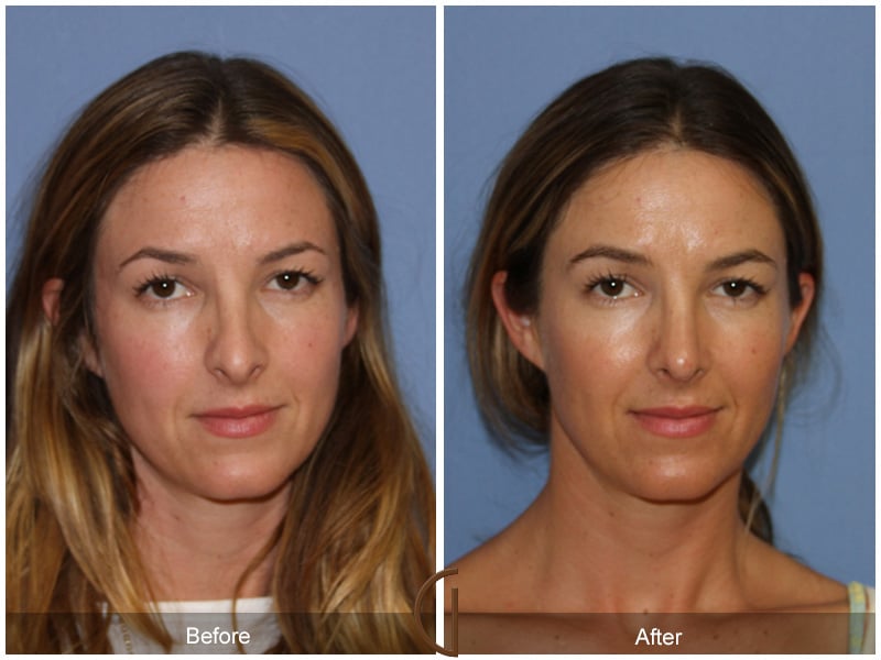 Rhinoplasty Nose Surgery Ladera Heights CA 64 Image