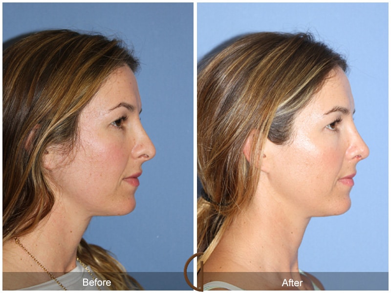 Rhinoplasty Nose Surgery Ladera Heights CA 64 Image