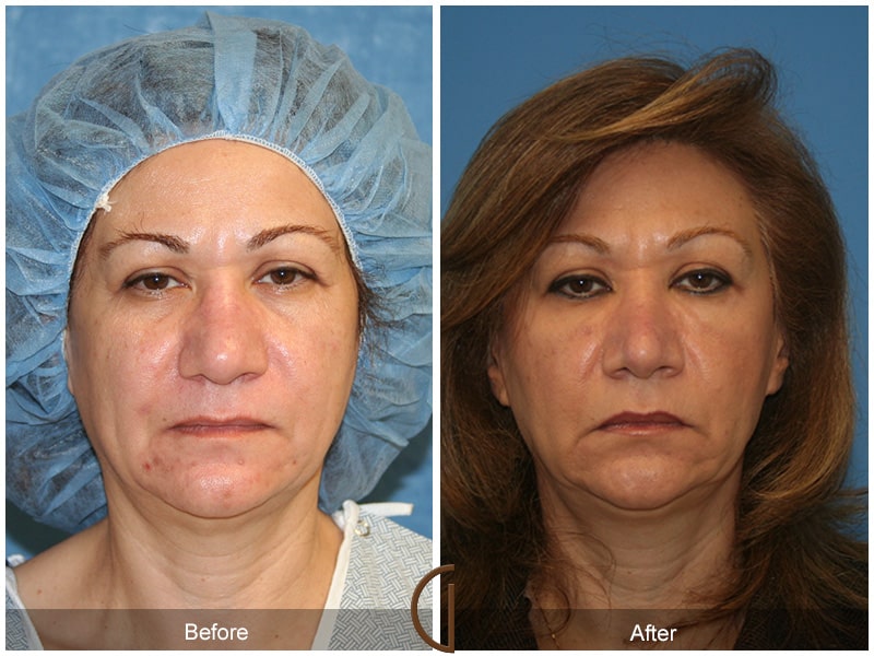 Rhinoplasty Nose Surgery Pine Valley CA 65 Image