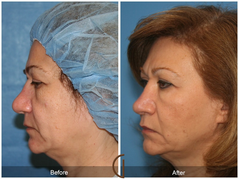 Rhinoplasty Nose Surgery Pine Valley CA 65 Image
