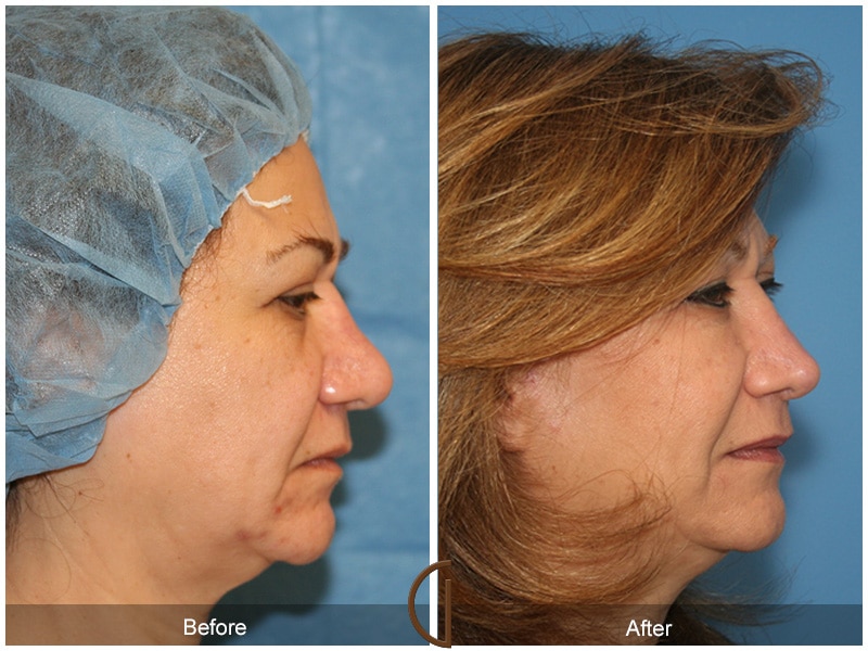 Rhinoplasty Nose Surgery Pine Valley CA 65 Image
