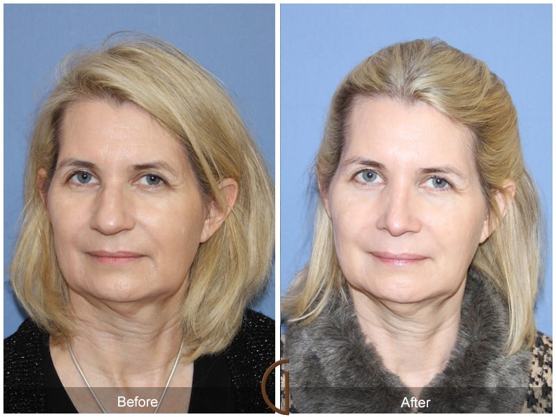 Rhinoplasty Nose Surgery El Sobrante CA 66 Image