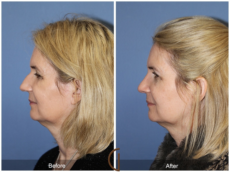Rhinoplasty Nose Surgery El Sobrante CA 66 Image
