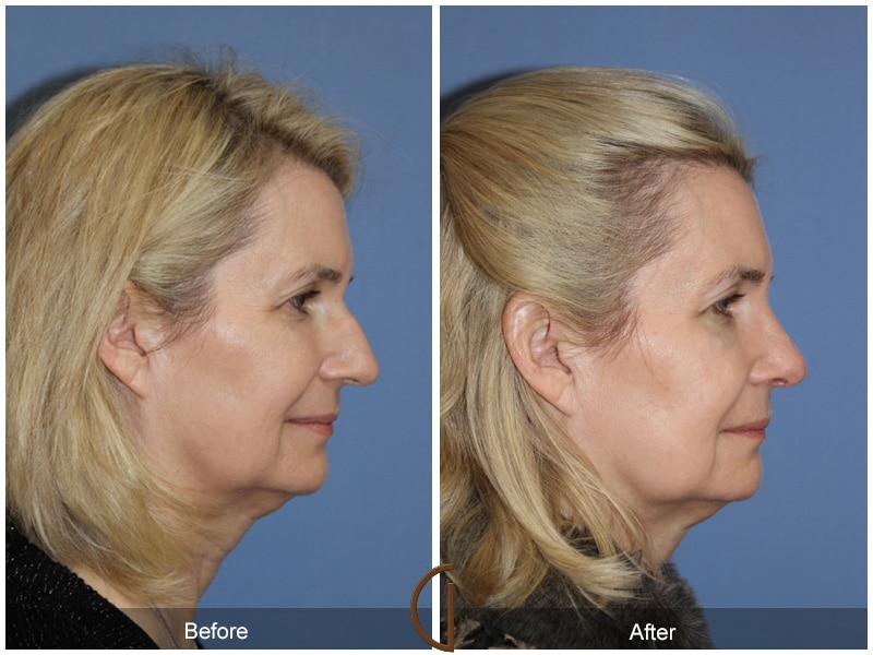 Rhinoplasty Nose Surgery El Sobrante CA 66 Image