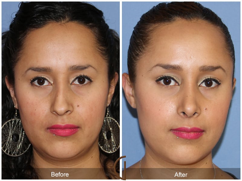 Ethnic Rhinoplasty Orange County 91 Image