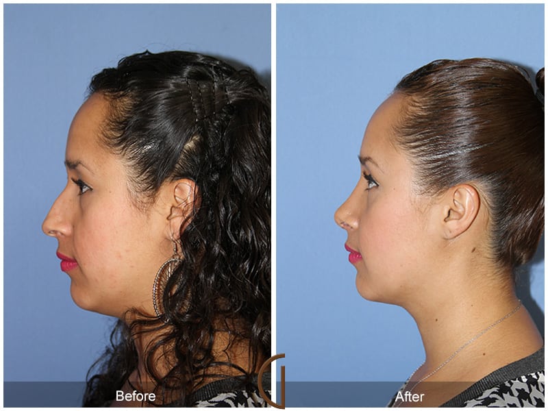 Ethnic Rhinoplasty Orange County 91 Image