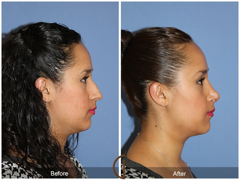 Ethnic Rhinoplasty Orange County 91 Image