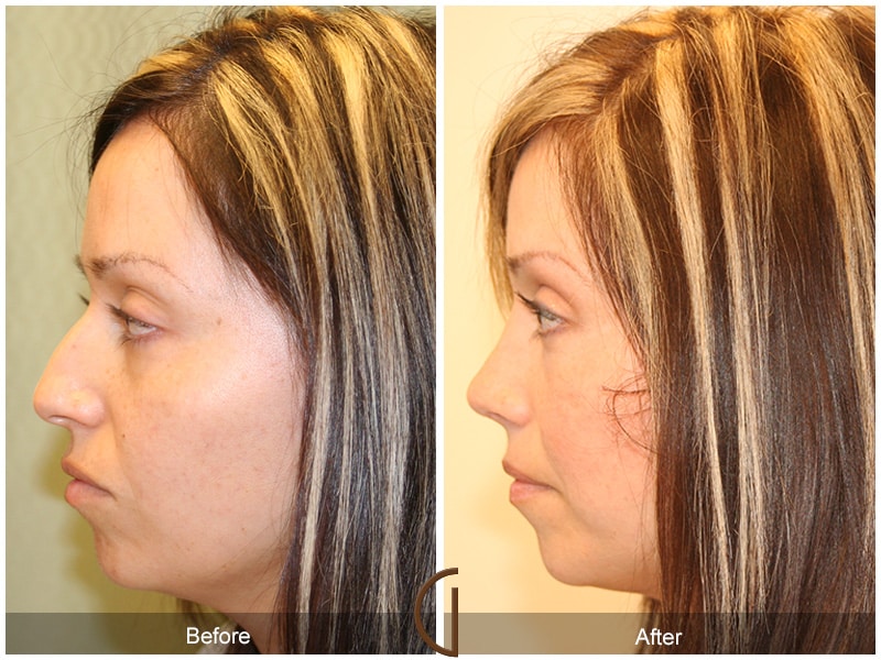 Rhinoplasty Nose Surgery Encinitas CA 7 Image