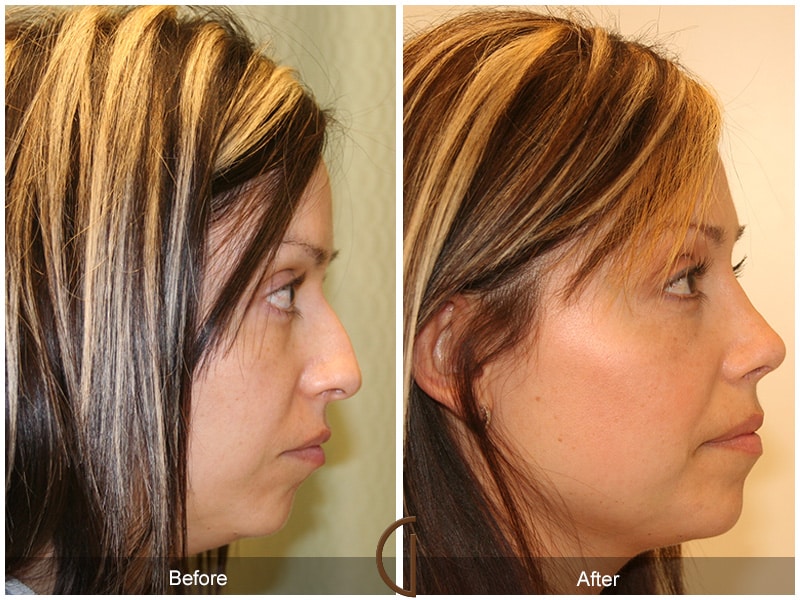 Rhinoplasty Nose Surgery Encinitas CA 7 Image