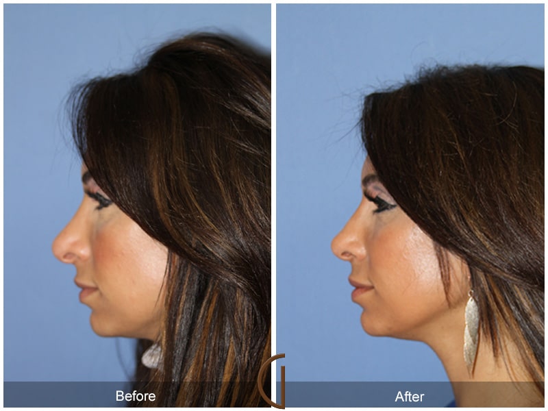 Ethnic Rhinoplasty Nose Surgery Acton 71 Image