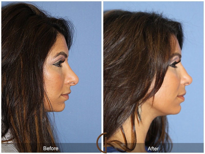 Ethnic Rhinoplasty Nose Surgery Acton 71 Image