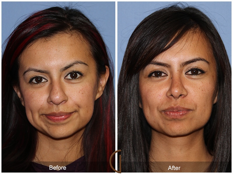 Rhinoplasty Nose Surgery Cerritos CA 72 Image