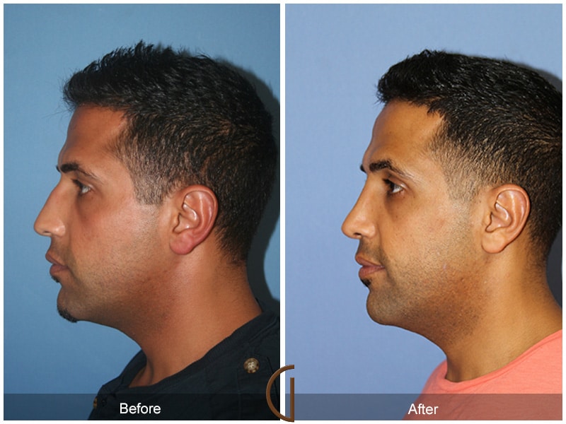 Rhinoplasty Nose Surgery Diamond Bar CA 73 Image