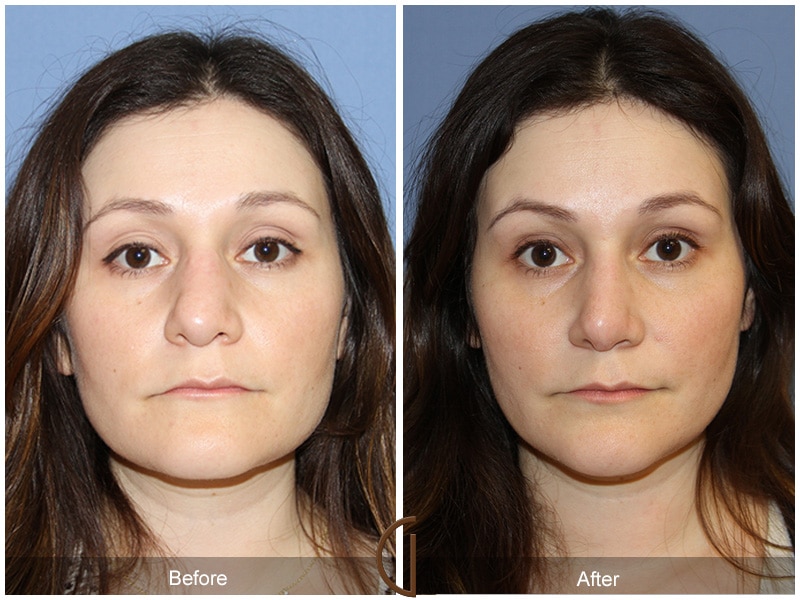 Rhinoplasty Nose Surgery Coronado CA 74 Image