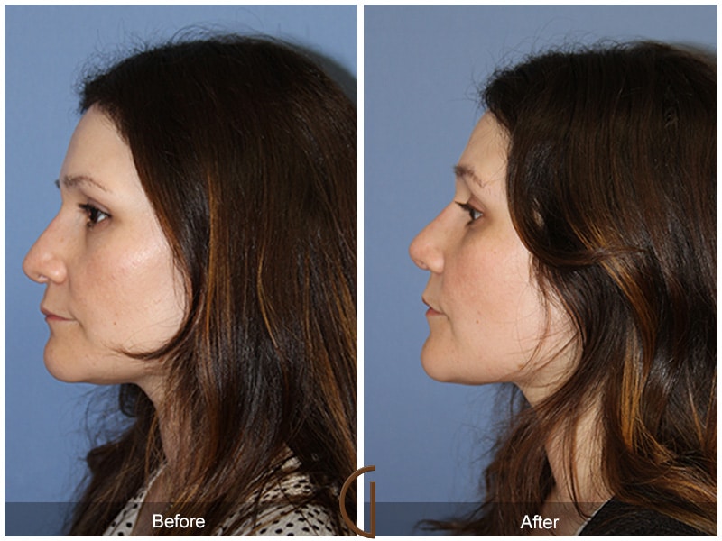 Rhinoplasty Nose Surgery Coronado CA 74 Image