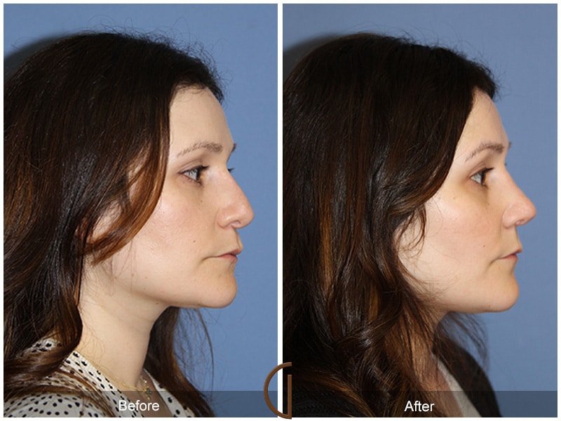 Rhinoplasty Nose Surgery Coronado CA 74 Image
