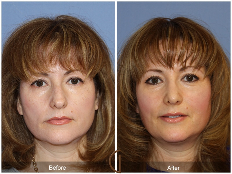 Rhinoplasty Nose Surgery Sierra Madre CA 75 Image