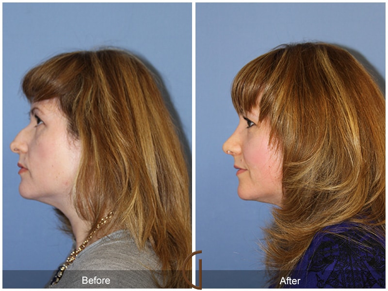 Rhinoplasty Nose Surgery Sierra Madre CA 75 Image