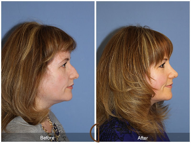 Rhinoplasty Nose Surgery Sierra Madre CA 75 Image