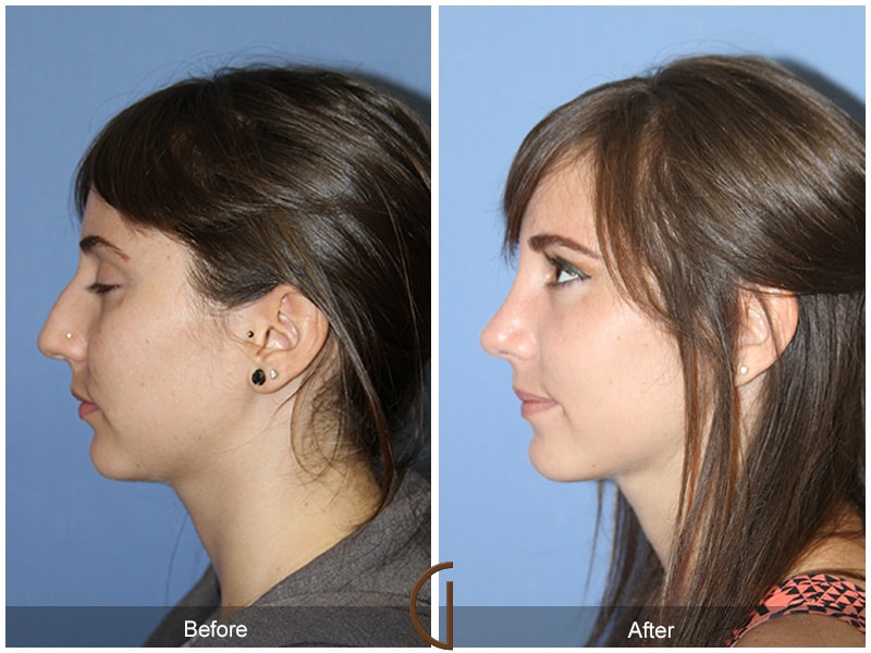 Rhinoplasty Nose Surgery Solana Beach CA 76 Image