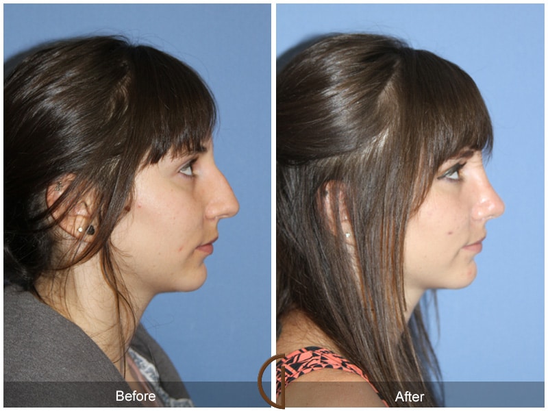 Rhinoplasty Nose Surgery Solana Beach CA 76 Image