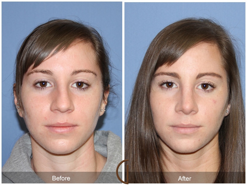 Rhinoplasty Nose Surgery La Crescenta-Montrose CA 77 Image