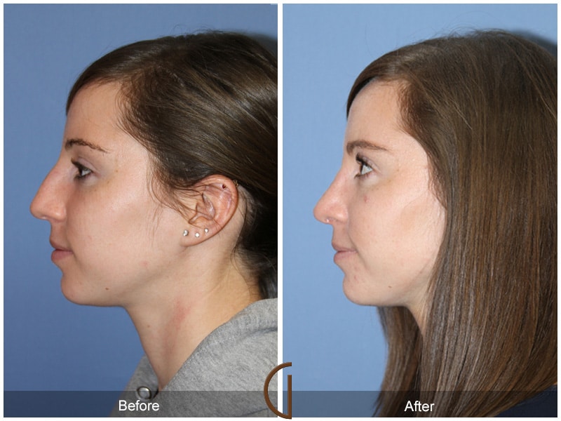 Rhinoplasty Nose Surgery La Crescenta-Montrose CA 77 Image