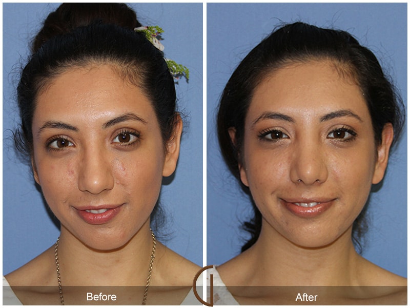 Rhinoplasty Nose Surgery Temescal Valley CA 79 Image