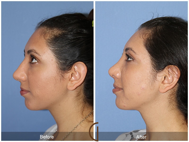 Rhinoplasty Nose Surgery Temescal Valley CA 79 Image