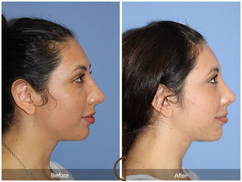 Rhinoplasty Nose Surgery Temescal Valley CA 79 Image