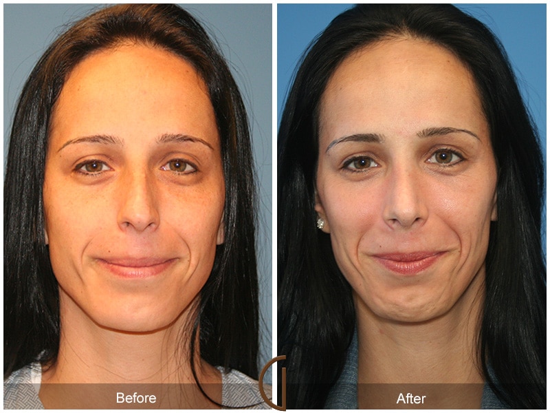 Rhinoplasty Nose Surgery Agua Dulce CA 8 Image