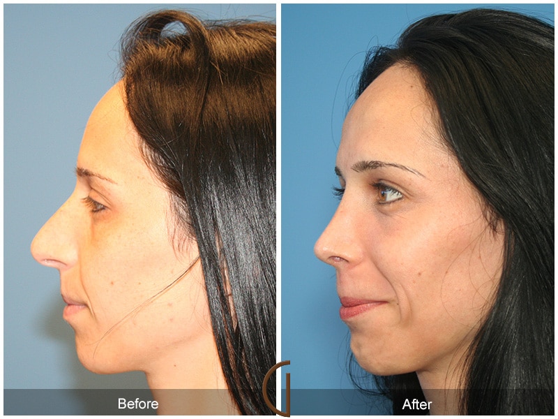 Rhinoplasty Nose Surgery Agua Dulce CA 8 Image