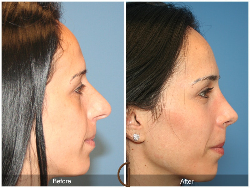Rhinoplasty Nose Surgery Agua Dulce CA 8 Image