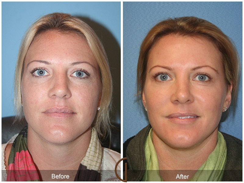 Rhinoplasty Nose Surgery French Valley CA 80 Image
