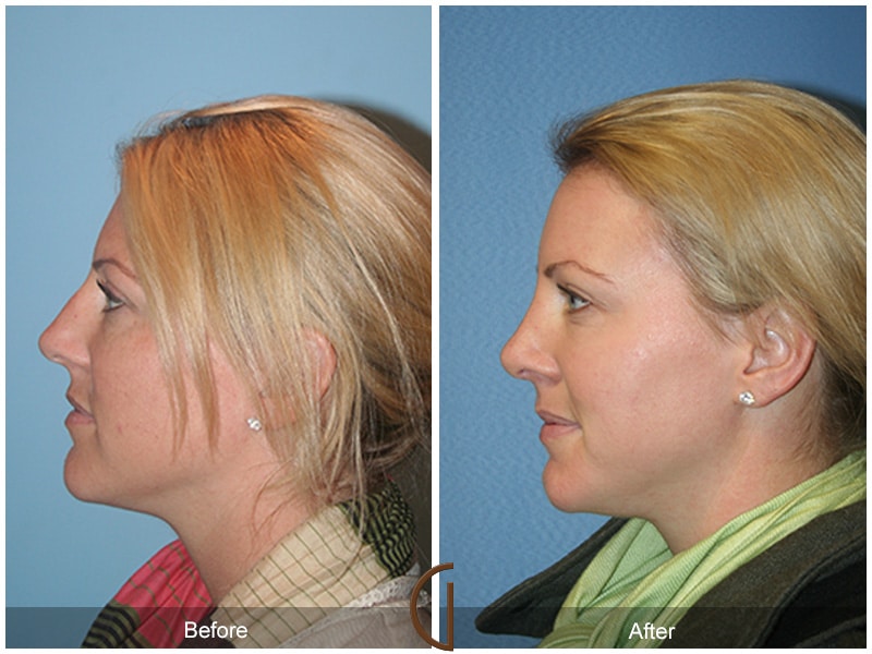 Rhinoplasty Nose Surgery French Valley CA 80 Image