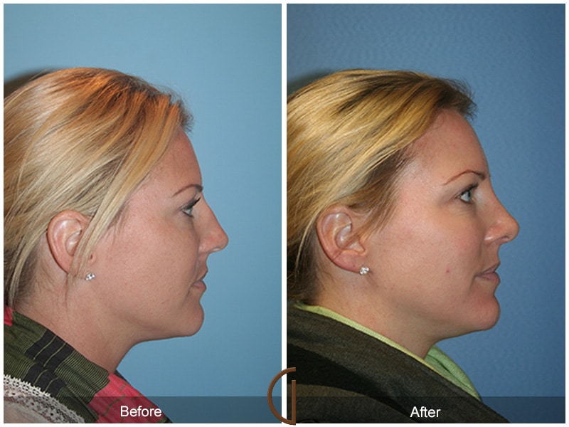 Rhinoplasty Nose Surgery French Valley CA 80 Image
