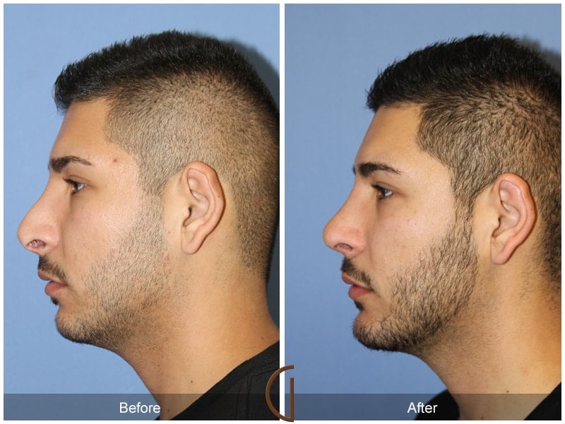 Rhinoplasty & Chin Ladera Ranch CA 82 Image