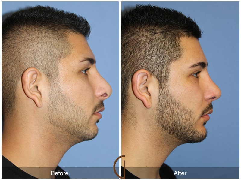 Rhinoplasty & Chin Ladera Ranch CA 82 Image