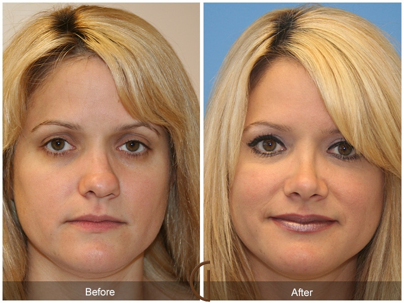 Rhinoplasty Nose Surgery Beverly Hills CA 9 Image
