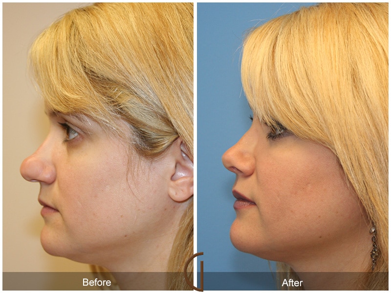 Rhinoplasty Nose Surgery Beverly Hills CA 9 Image
