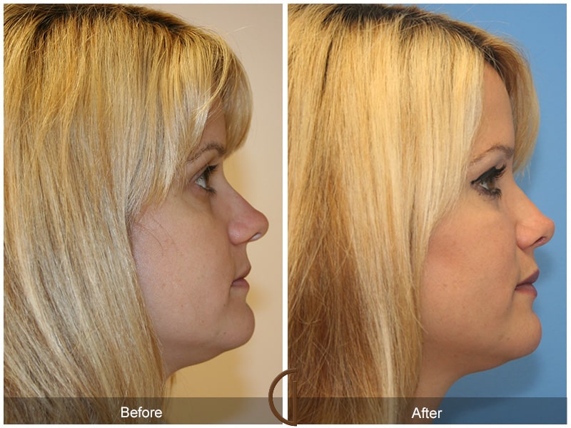 Rhinoplasty Nose Surgery Beverly Hills CA 9 Image
